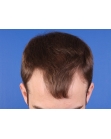 Before Hair Transplant&nbsp;Hairlines